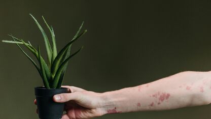 Is eczeem besmettelijk?