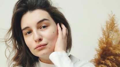 Deze pimple patches werken het beste