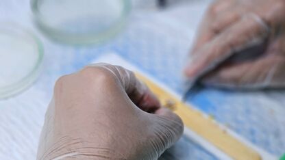 De weg naar natuurlijk uitziend haar met FUE transplantatie